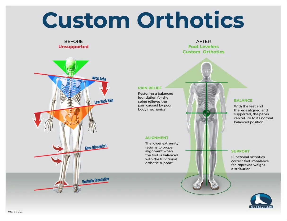 Before and after custom orthotics alignment