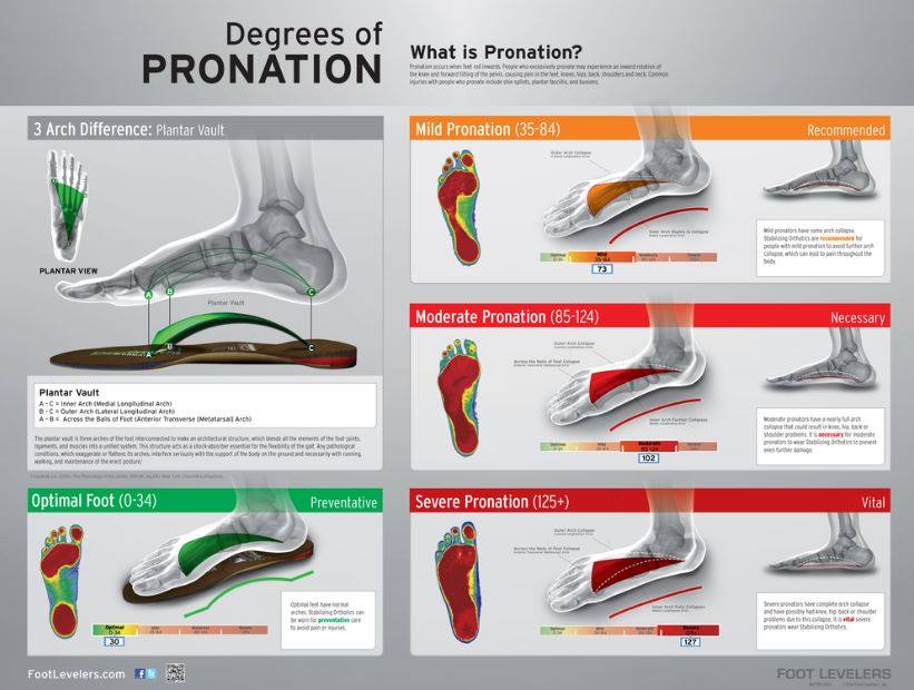 Chart showing the degrees of foot pronation from normal to severe overpronation